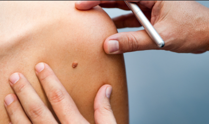 Chirurgie des grains de beauté